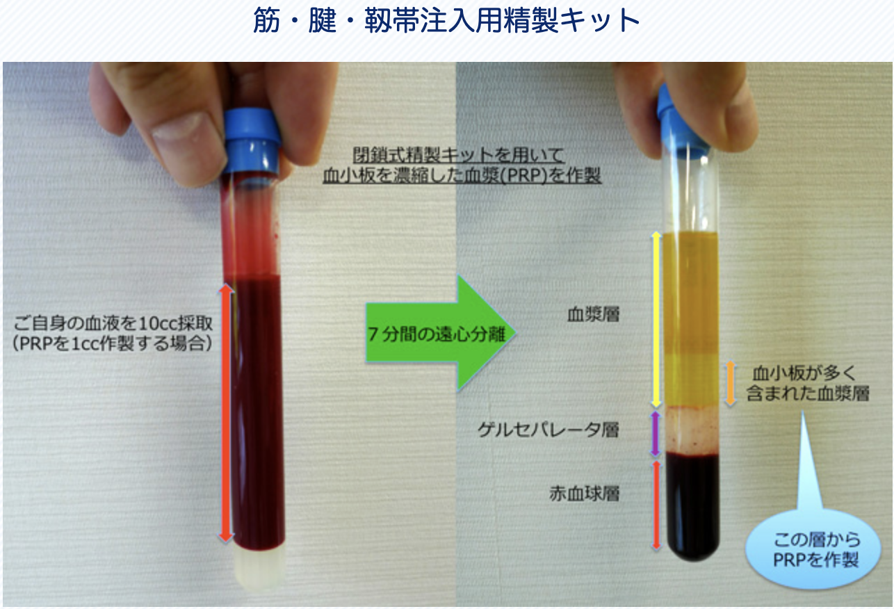 筋・腱・靱帯注入用精製キット