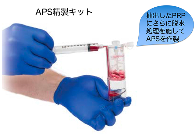 ASP精製キット