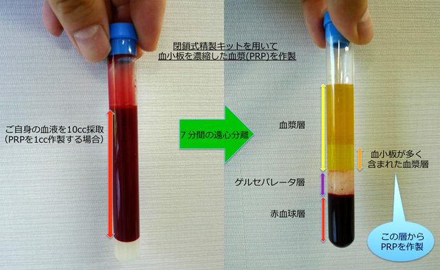 閉鎖式精製キットを用いて血小板を濃縮したPRPを作製